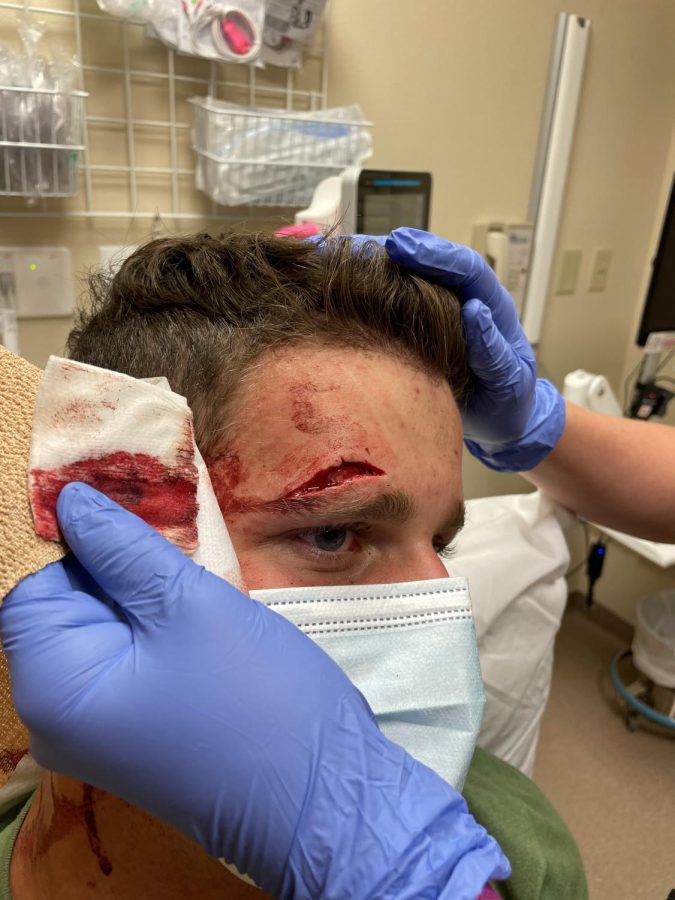 In an intense game of tag at summer camp, sophomore Rylan Stoner collides with a camp counselor, earning a deep gash.
"Not fun at the time, but worth it for the scar," Stoner said.